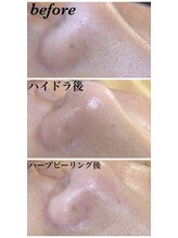 サロンドソエ(Salon de Soe)/毛穴洗浄&ハーブピーリング