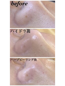 サロンドソエ(Salon de Soe)/毛穴洗浄&ハーブピーリング
