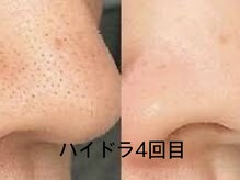 ウェルビーイング(well-being)の雰囲気（ハイドラでニキビの原因皮脂除去＆ハーブピーリングでニキビケア）