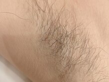 ルゥルゥ シュガーリング(Luu Luu sugaring)/シュガーリング脱毛/代々木上原