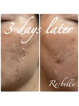 チップ(chip)/剥離は個人差があります