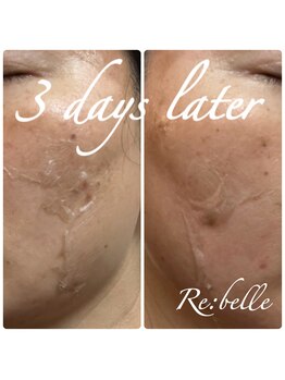 チップ(chip)/剥離は個人差があります