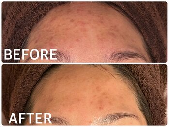 ハーブピーリング 恵比寿/ニキビ/くすみ沈着/肌質改善