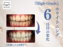 ホワイトニングボックス 豊川店/施術6回目終了後