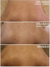 ベビースキン(baby skin)/背中ニキビ改善