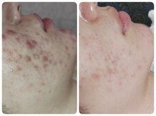 ティアス(t-us)/【ニキビ】タラソorハーブ