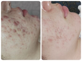 ティアス(t-us)/【ニキビ】タラソorハーブ