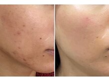 ビプラス(VIPLAS)/プラズマエステ（ニキビケア）