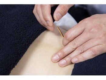 鍼灸J/O治療院/鍼灸施術有ります。[自由が丘]