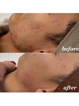 ベル(belle)/ニキビケア