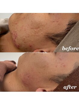 ベル(belle)/ニキビケア