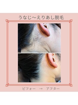 ノノ(nono)/うなじ～えりあし脱毛