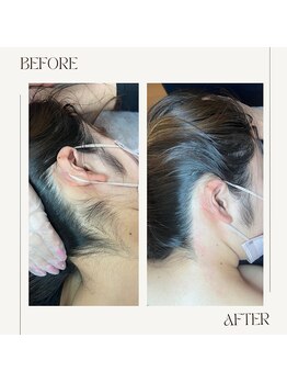 スプランドゥール(Splendeur)/うなじ ワックス脱毛&光脱毛