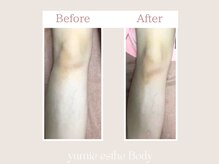 トータルビューティー ゆみえエステ(Total Beauty)/