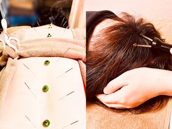 仁接骨院 じん鍼灸治療院の写真/長時間のデスクワーク、スマートフォンの使用で首肩のコリが気になる方にオススメ☆丁寧な施術で根本改善◎