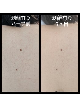 アリビオ(ALIVIO)/背中ハーブピーリング