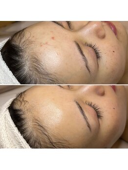 エクラムサロン 代官山(eclam salon)/施術BEFORE／AFTER