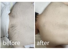 カヌヌ(kanunu)/部分脱毛/背中・うなじ