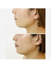 ルミア(LUMIA)/小顔造形ロイヤルコース１回目