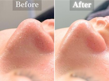 ボーンオム(Born Homme)/毛穴洗浄+美容液導入:20代女性