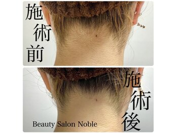 ノーブル(Noble)/襟足・うなじ脱毛