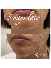 チップ(chip)/剥離は個人差があります