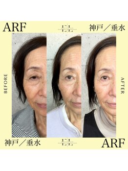 アーフ(ARF)/エクソリフト