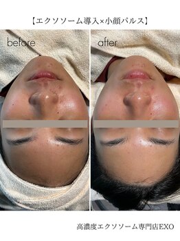 エクソ 吉祥寺(EXO)/エクソソーム×小顔の結果写真