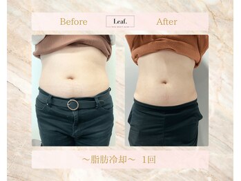 リーフ(Leaf.)/脂肪冷却ダイエット