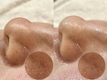 ノギ 一宮店(nogi)/韓国式毛穴洗浄"アクアピール"