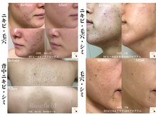 ローズフィールド(Rosefield)の雰囲気（RFピール/毛穴/シミ/ニキビ/その他症例多数はフォトギャラリーへ）