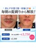 【メンズ脱毛】期間限定！髭ツルツルに！お得な4回分☆