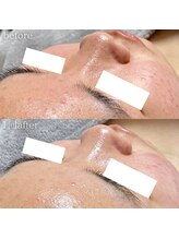 クレヴィー(Creviy)/韓国式3D毛穴洗浄＆REVlハーブ