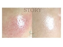 ストーリー(STORY)/ハーブピーリング専門店STORY