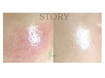 ストーリー(STORY)/ハーブピーリング専門店STORY