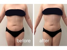 ナチュラル ユース(Natural youth)/お腹周りのbefore/after