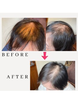 レメディ/グロスファクター育毛促進鍼