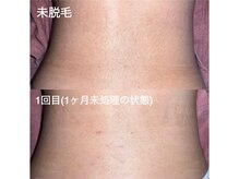 エピジュ(Epijyu)/女性の腰脱毛