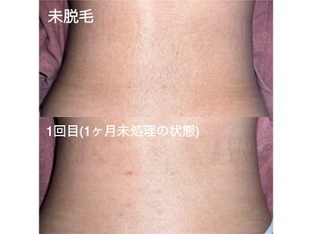 エピジュ(Epijyu)/女性の腰脱毛