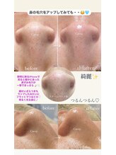 クレヴィー(Creviy)/3D毛穴洗浄×ハーブピーリング