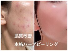 リジュベネ(rejuvena)/本格肌質改善ハーブピーリング