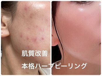 リジュベネ(rejuvena)/本格肌質改善ハーブピーリング