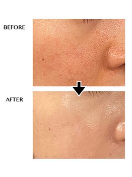 シンシア(sincere)/サーマナイフ★肌質改善/肌管理