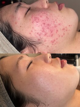 ビューティリュクス(beauty luxe)/しつこいニキビが気になる方へ！