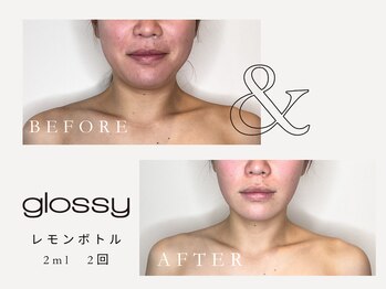 グロッシー(glossy)/【症例】レモンボトル小顔20代