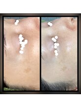 ココスタイルビューティー(COCOSTYLE beauty)/シミケア【し放題】