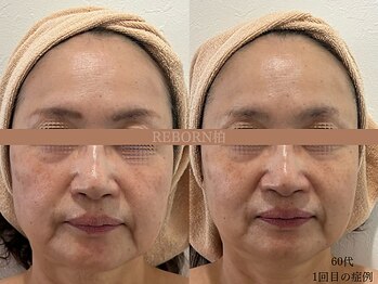 リボーン 柏(REBORN)/“削らず育てる”柏の再生美容