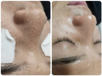 カヌヌ(kanunu)/ハイドラ毛穴洗浄