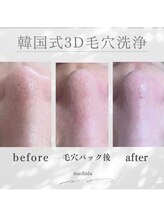 ホワイトニングショップ 町田店/【毛穴悩み】韓国式3D毛穴洗浄