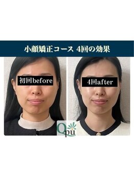キュープ 浜松店(Qpu)の写真/美顔器のケアで小顔になりながら美肌を目指せる!理想の自分へ近づく特別な日♪